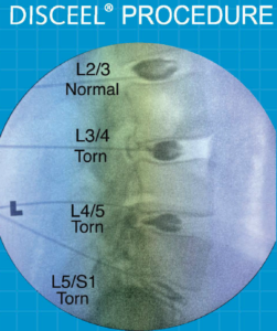 What is an Annular Tear and Leaky Disc Syndrome and What is Their