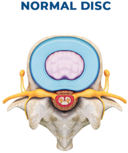 Annular Tear & Leaky Disc Treatment Options | Integrative Rehab Medicine