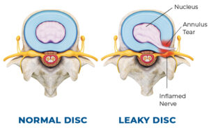Discseel® Procedure - Integrative Rehab Medicine